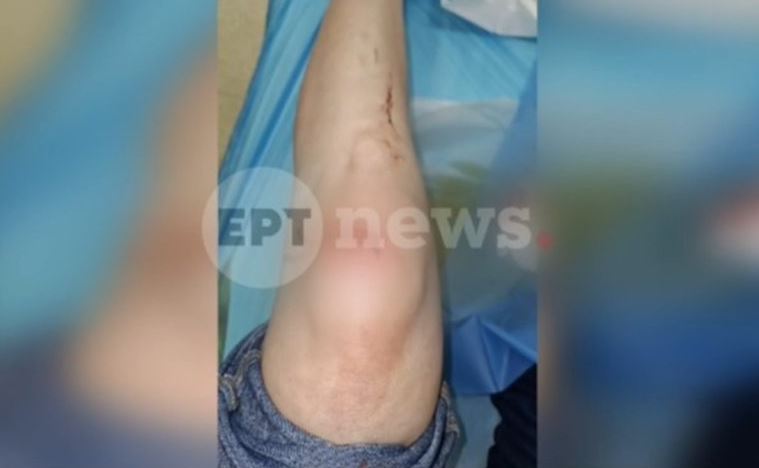Πάτρα: Συγκλονίζει η γυναίκα που δέχτηκε άγρια επίθεση – «Έχω κατάγματα και μώλωπες»